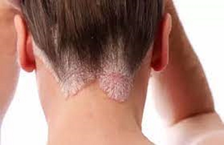 La ANMAT aprob&oacute; un nuevo medicamento para la psoriasis moderada a severa
